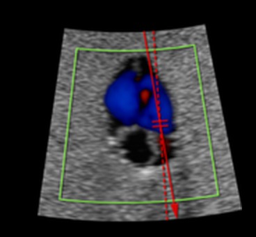 Colour Doppler ultrasound image of the beating phantom heart with blood flow in the chambers