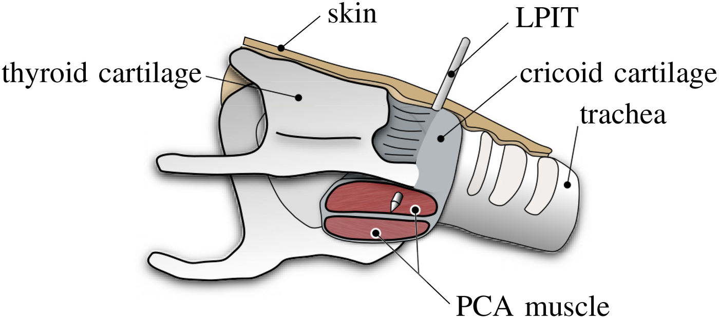 Schematic larynx with skin, thyroid and cricoid cartilage, trachea, the PCA muscle and the inserted LPIT