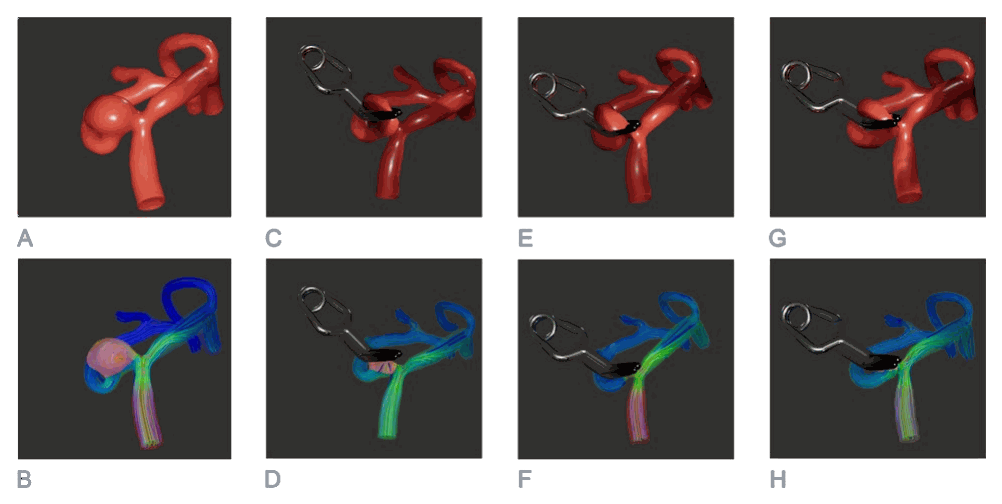 Virtual aneurysm before and after clipping with corresponding blood flow simulations
