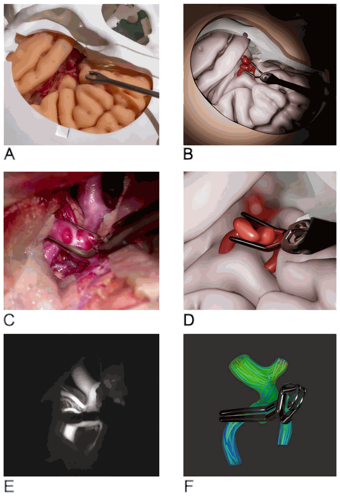 Physical and virtual operating fields side by side, a real and a virtual clipping of the same aneurysm, ICG angiography and simulated blood flow